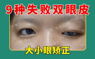 Download Video: 9种失败双眼皮