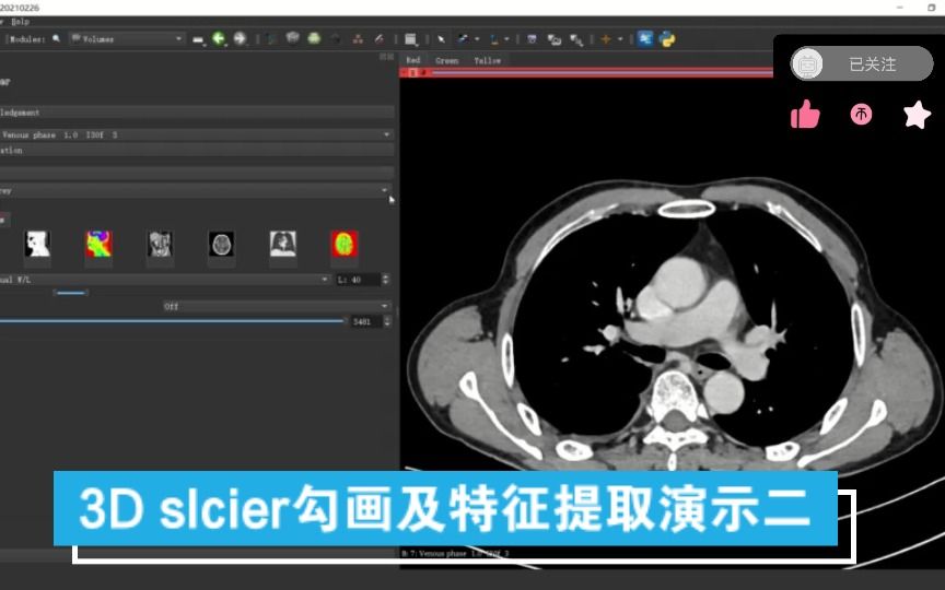 【影像组学】3D slcier勾画及特征提取演示二哔哩哔哩bilibili