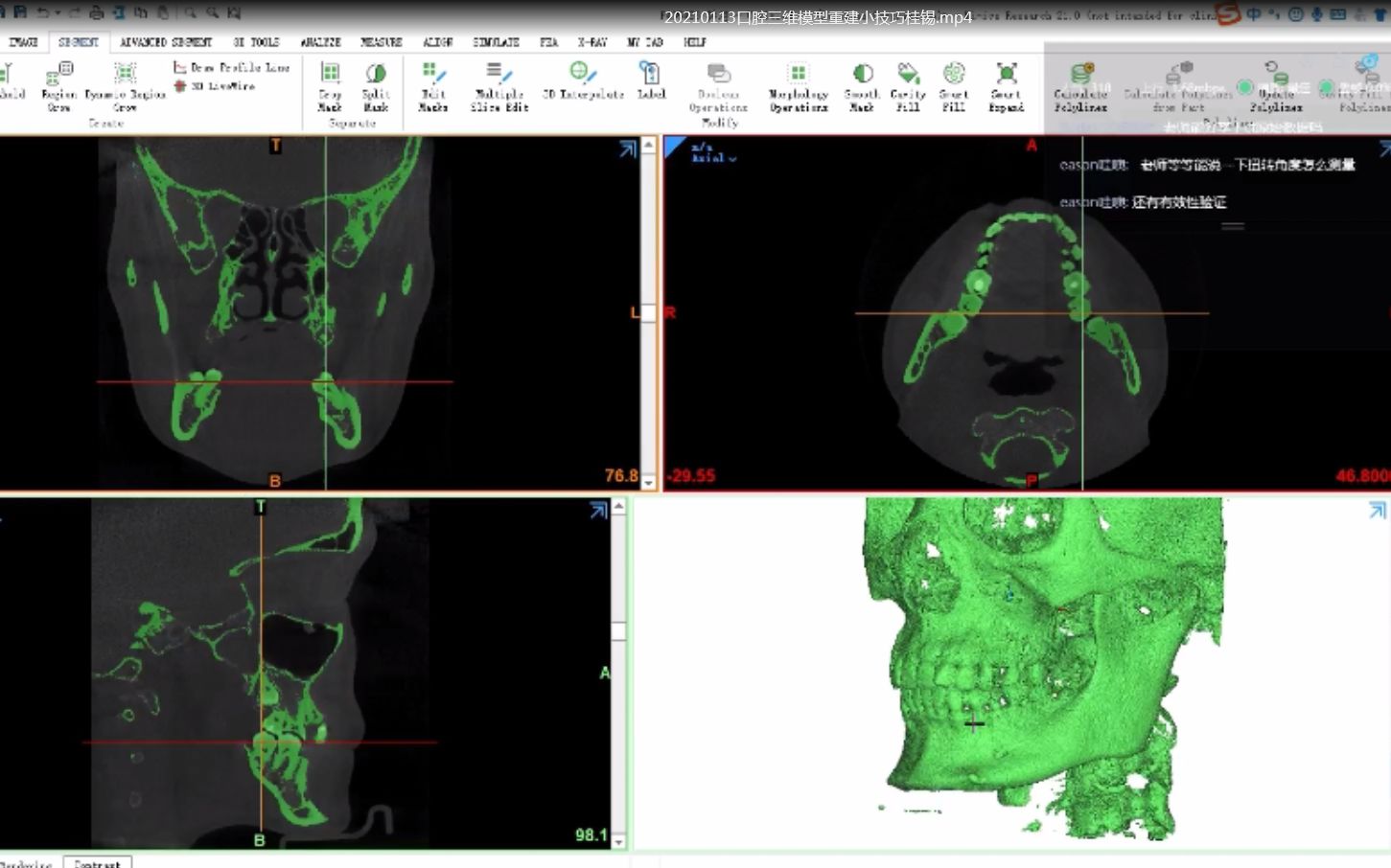 口腔医学有限元公开课mimics软件:牙齿三维模型重建小技巧分享哔哩哔哩bilibili