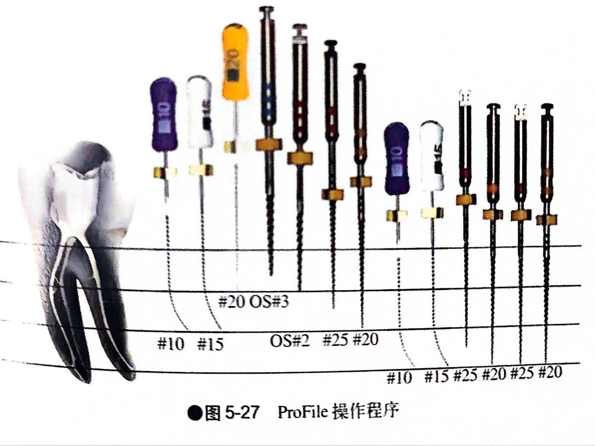 RCT根管预备(机扩)哔哩哔哩bilibili