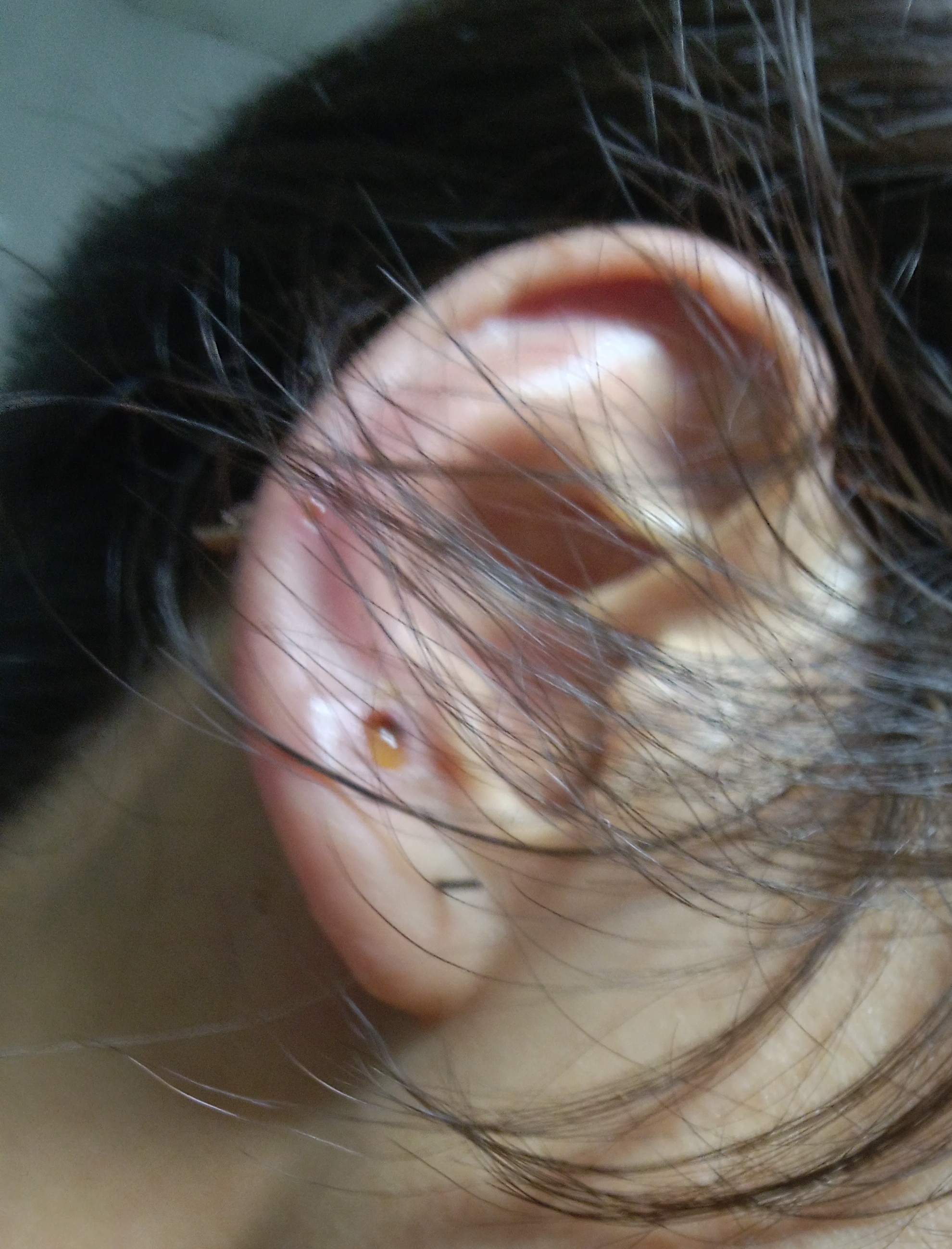 耳骨钉化脓图片