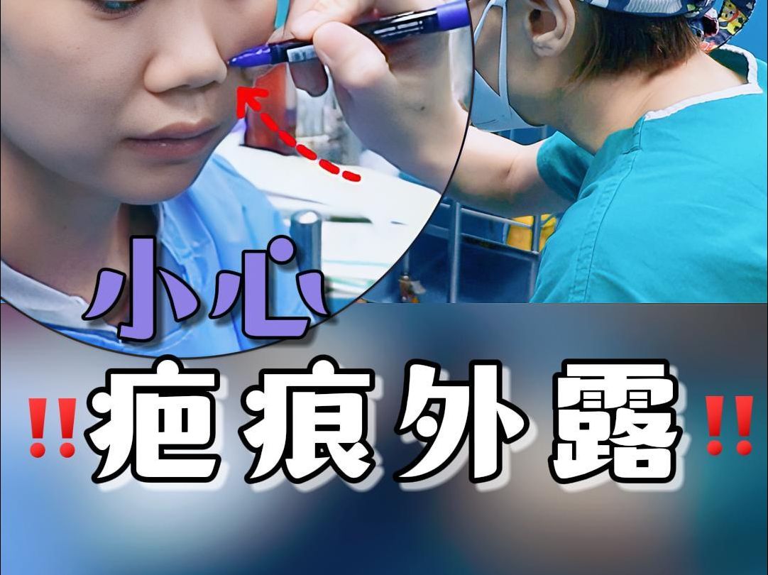 缩鼻翼切口疤痕隐蔽性很重要