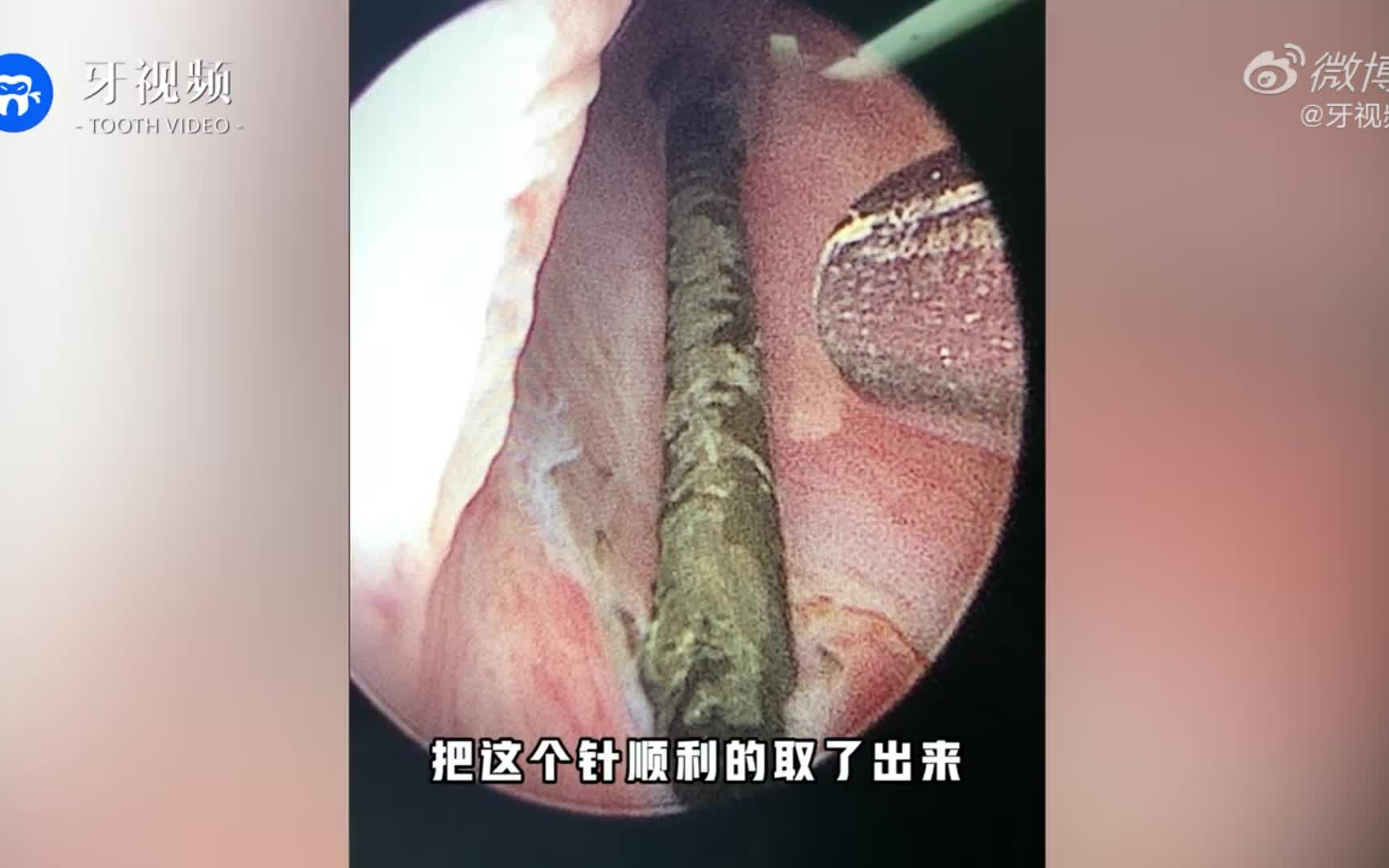 看着就疼 12岁男孩将8厘米长针插入尿道