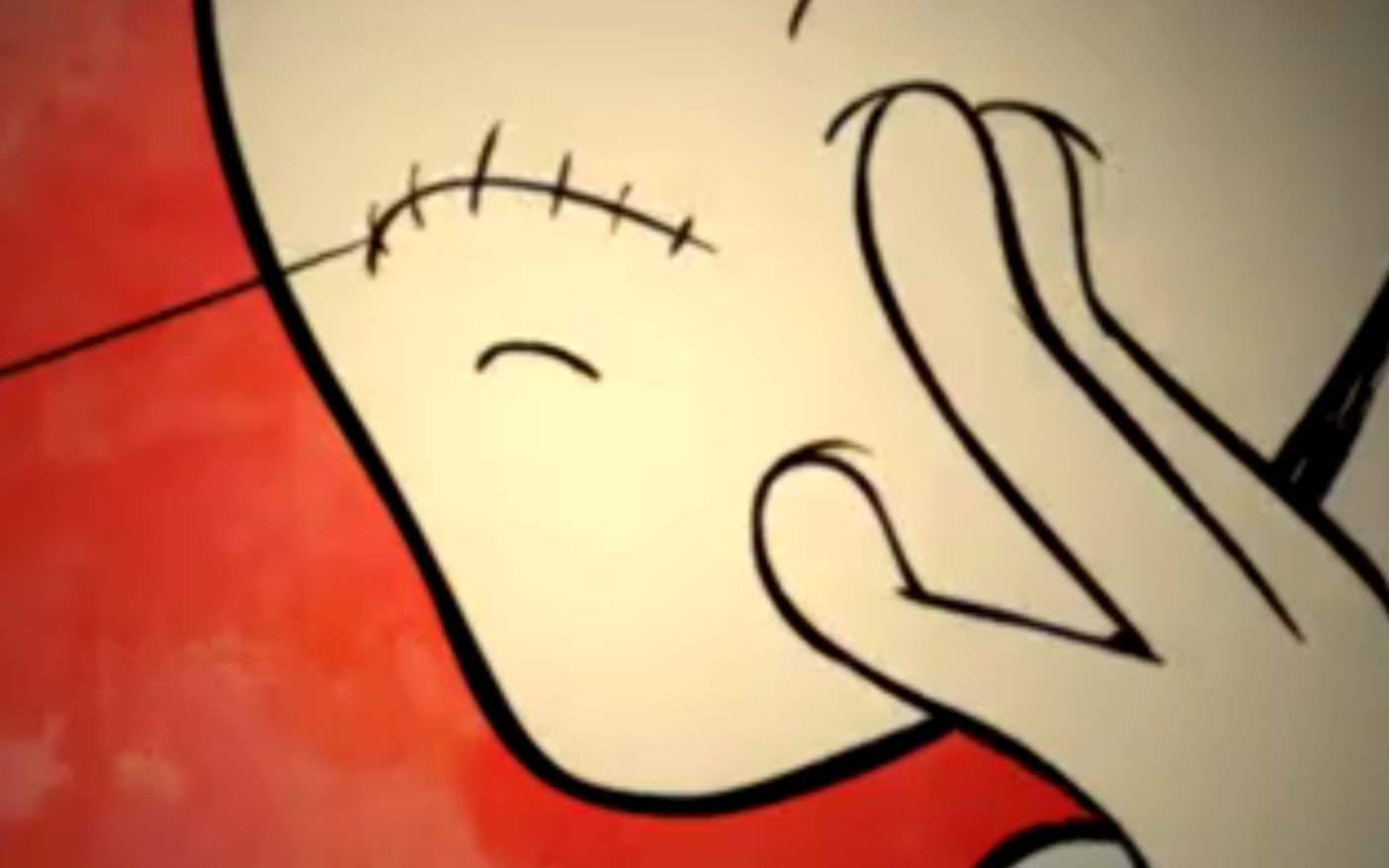 小伙天生没有嘴为了能和正常人一样他用针线给自己缝了个嘴巴