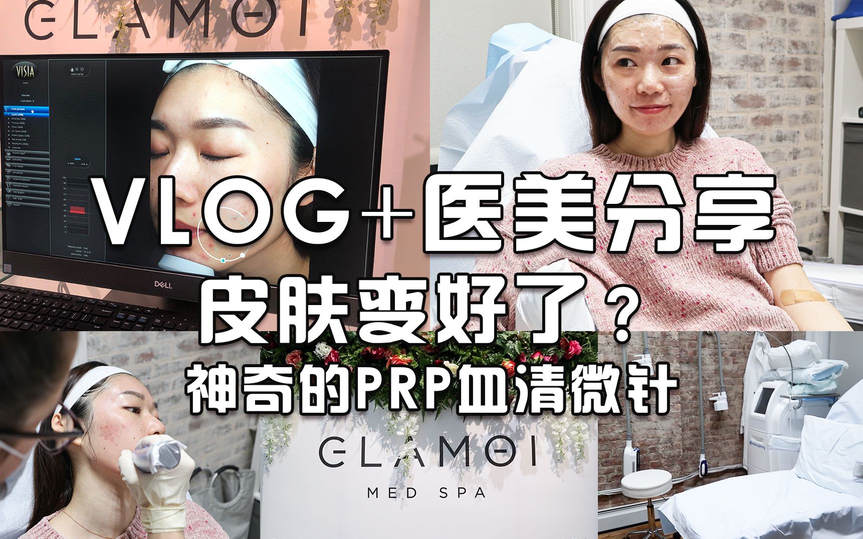 纽约医美分享 | 做了神奇的PRP血清微针,皮肤变好了?!拯救了我的痘印和大毛孔?素颜+血腥画面慎入!!哔哩哔哩bilibili