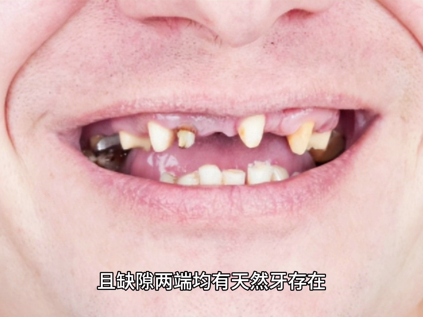 5.2 牙列缺损及可摘局部义齿的分类