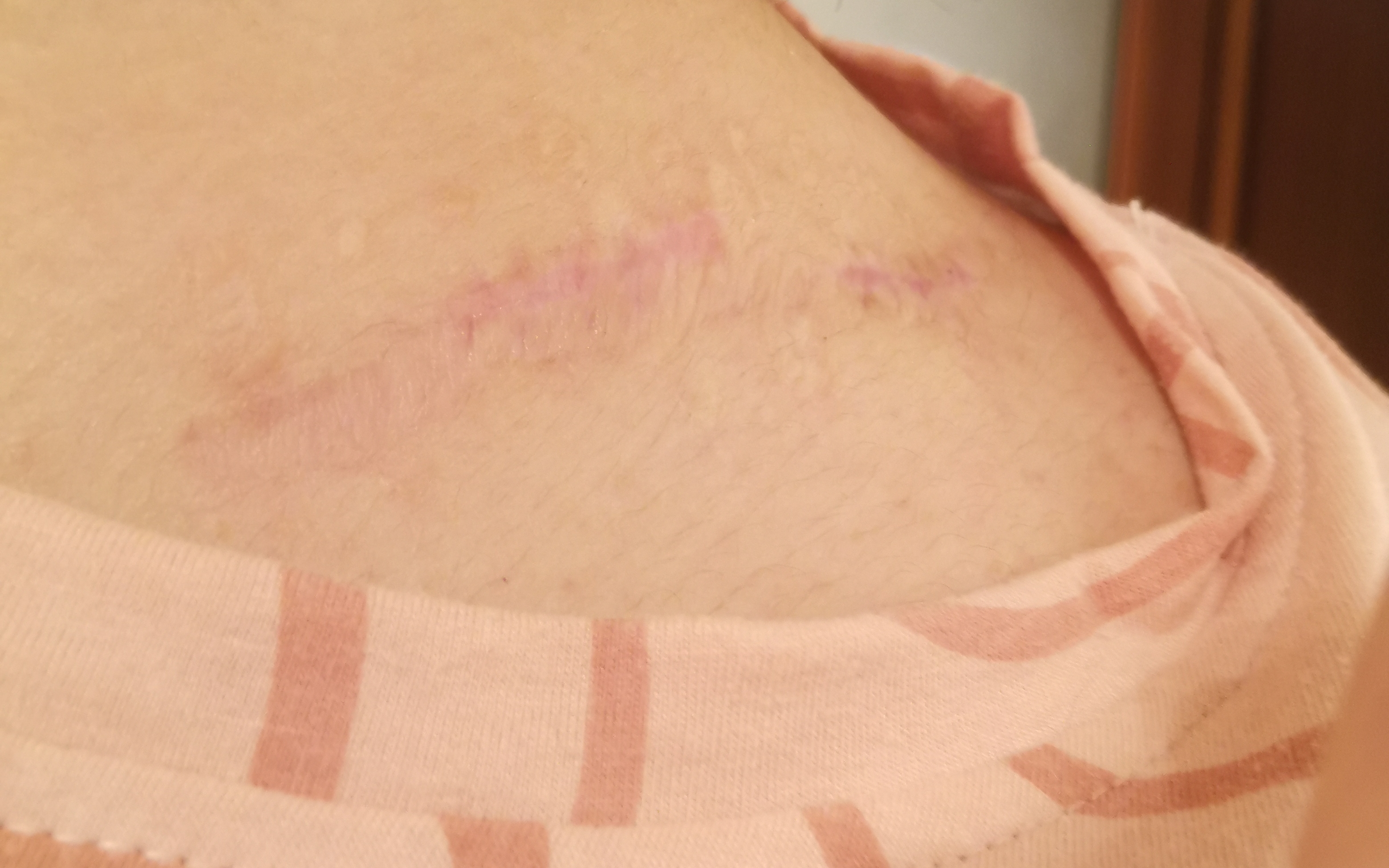 锁骨骨折手术疤痕图片图片