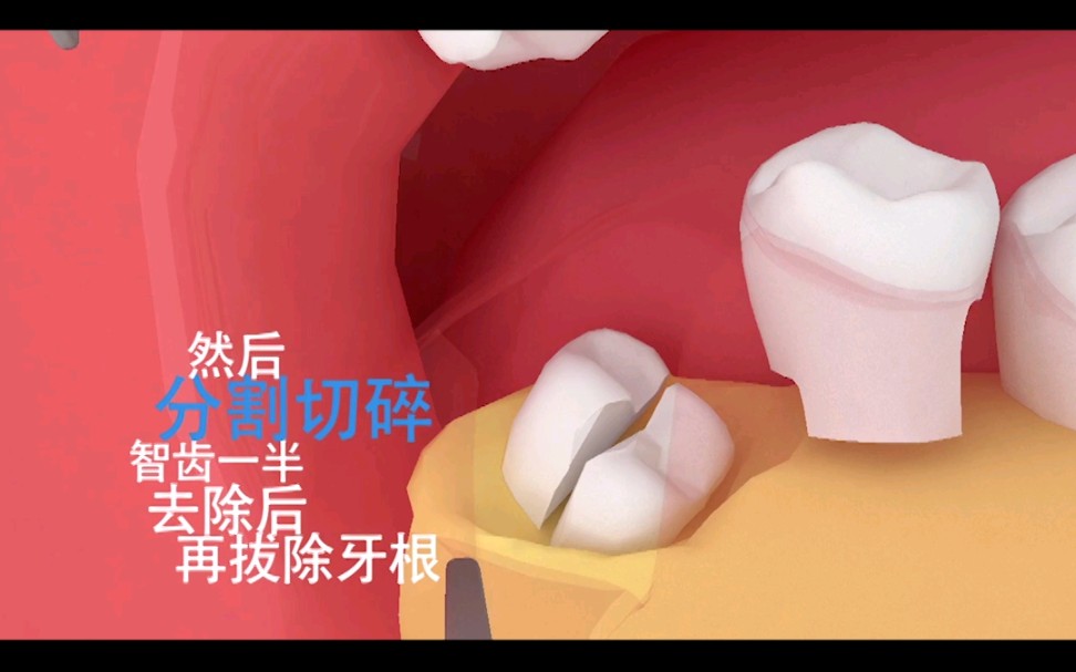 3D演示手术拔智齿,这过程很酸爽哔哩哔哩bilibili