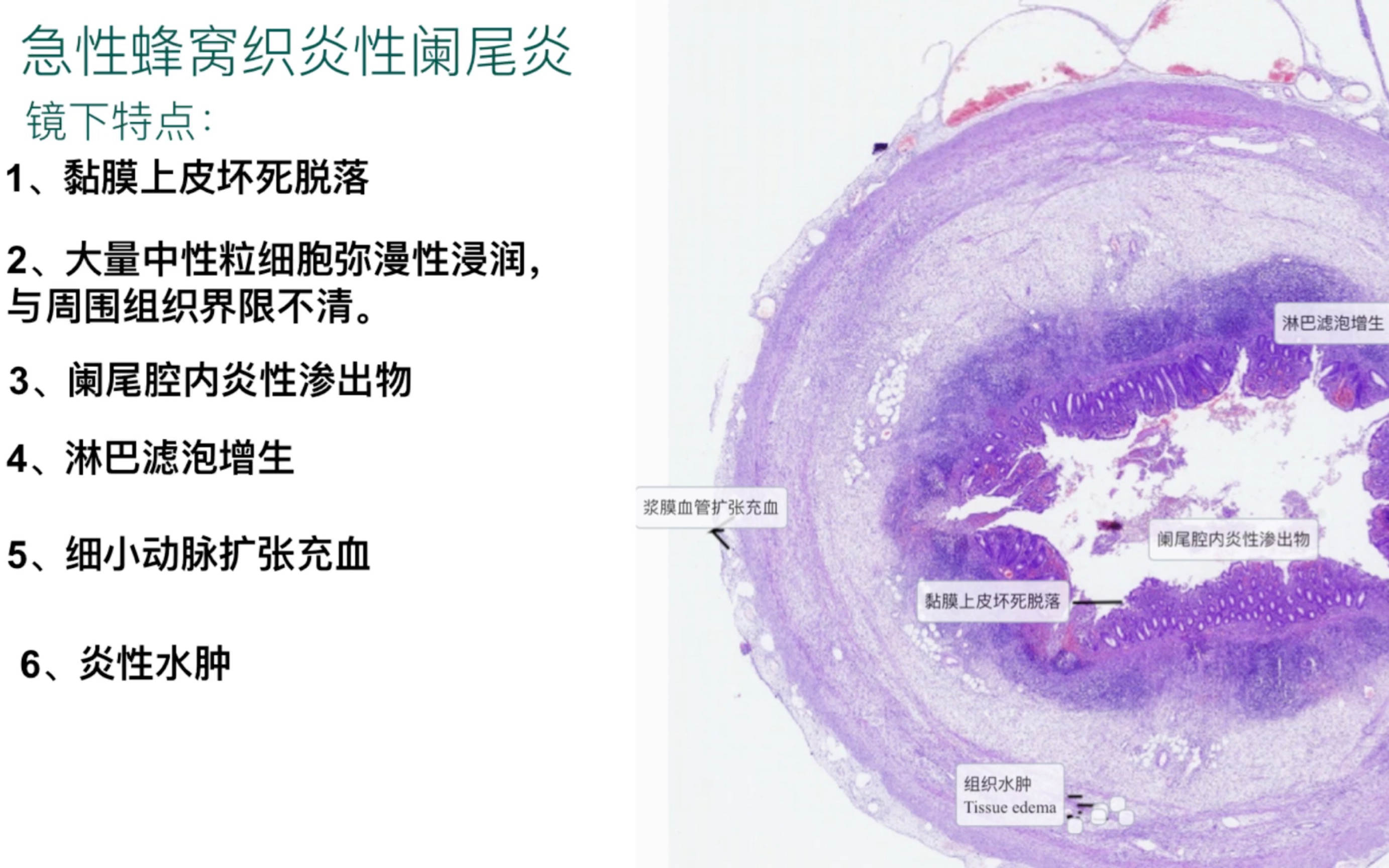 急性蜂窝织炎性阑尾炎切片讲解哔哩哔哩bilibili