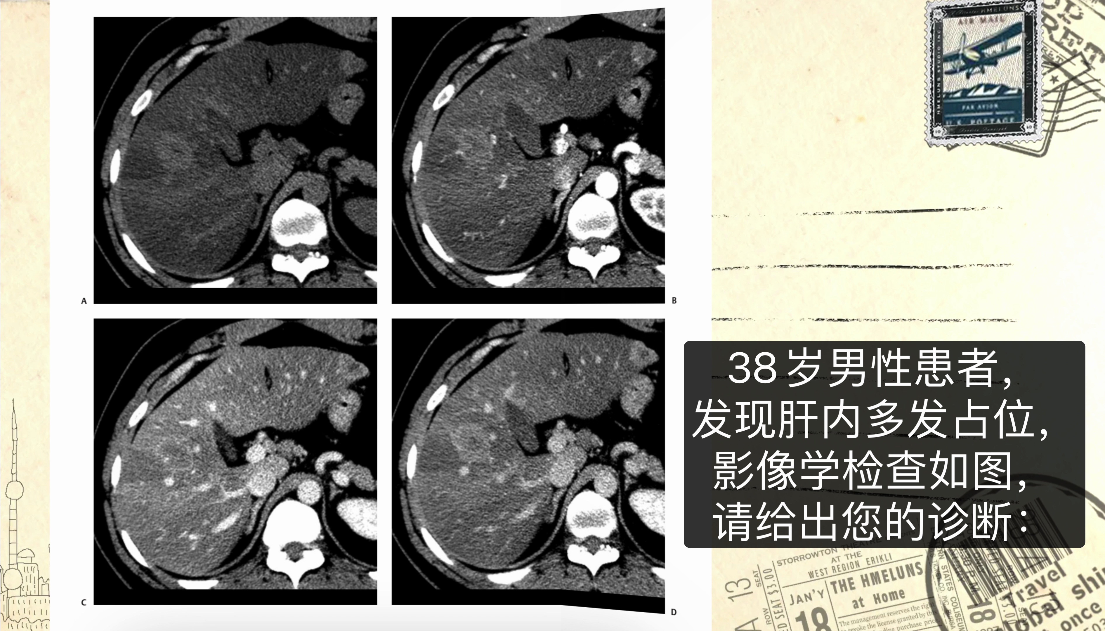 38岁男性发现肝内多发占位病灶,影像学诊断为?哔哩哔哩bilibili