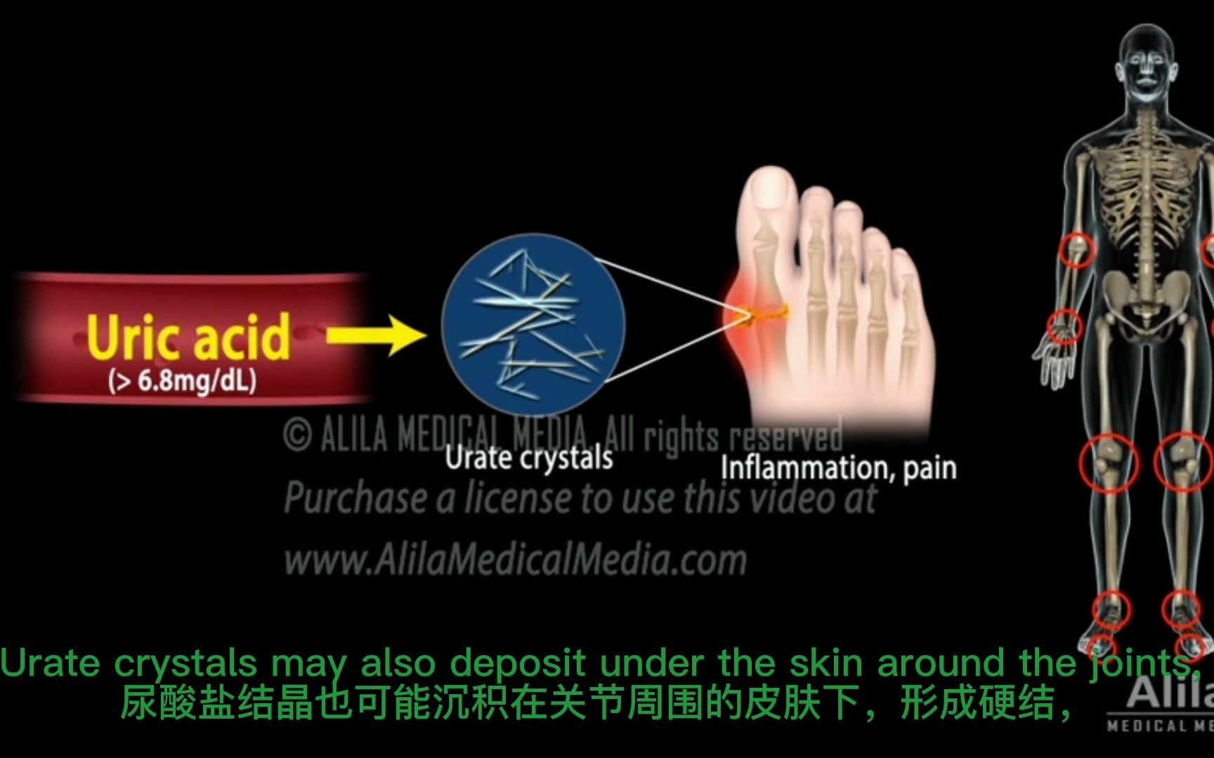 [图]自译自学用 I 医学动画 I 痛风(病理生理学，病因，症状，危险因素，诊断和治疗)