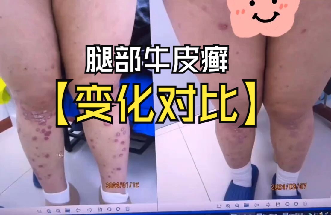 女子腿部牛皮癣 变化对比