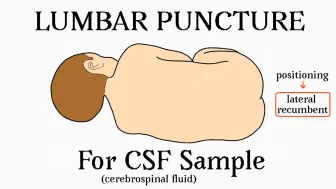 Скачать видео: 腰椎穿刺术