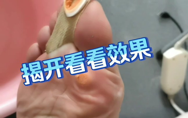 鸡眼贴效果怎么样?贴完六片鸡眼恢复的的过程分享哔哩哔哩bilibili