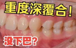 Tải video: 重度深覆合❗下巴极度后缩❗一位青少年的逆袭之路💥