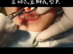 Download Video: 新型豆瓣成型片套装！可调节力度，可更换夹子头！操作简单，完美修复二类洞！