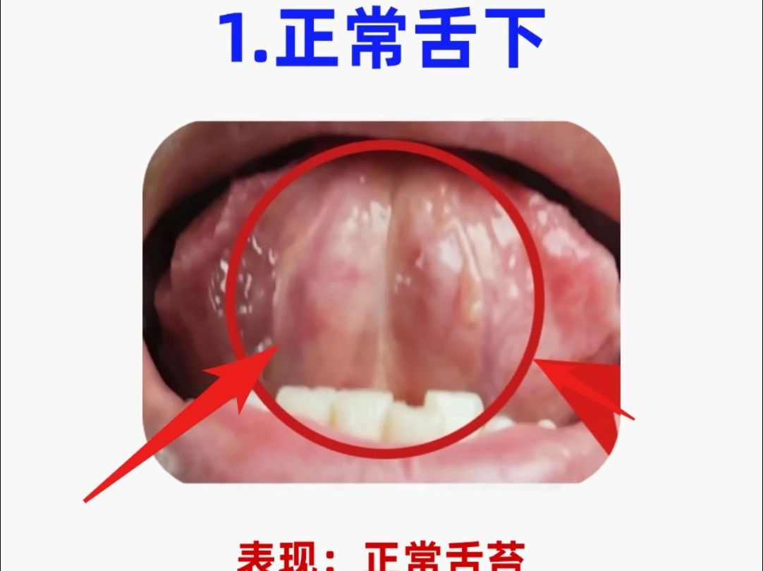 舌诊分析:看舌下辩健康,六种常见舌下,对镜自查哔哩哔哩bilibili