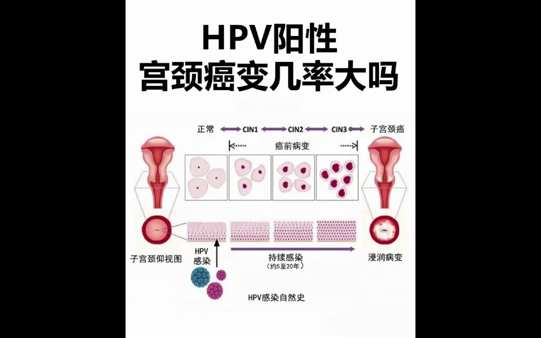 hpv陽性宮頸癌變幾率大嗎 廣州科大中醫醫院