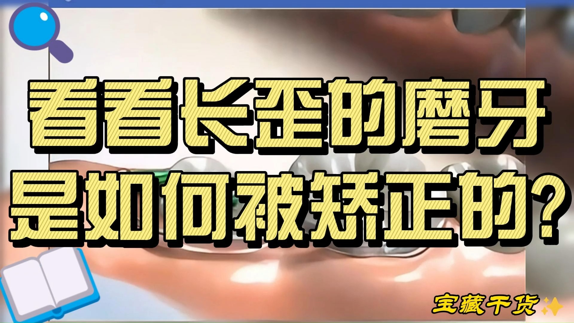 北京牙齿矫正:看看长歪的磨牙是如何被矫正的?哔哩哔哩bilibili