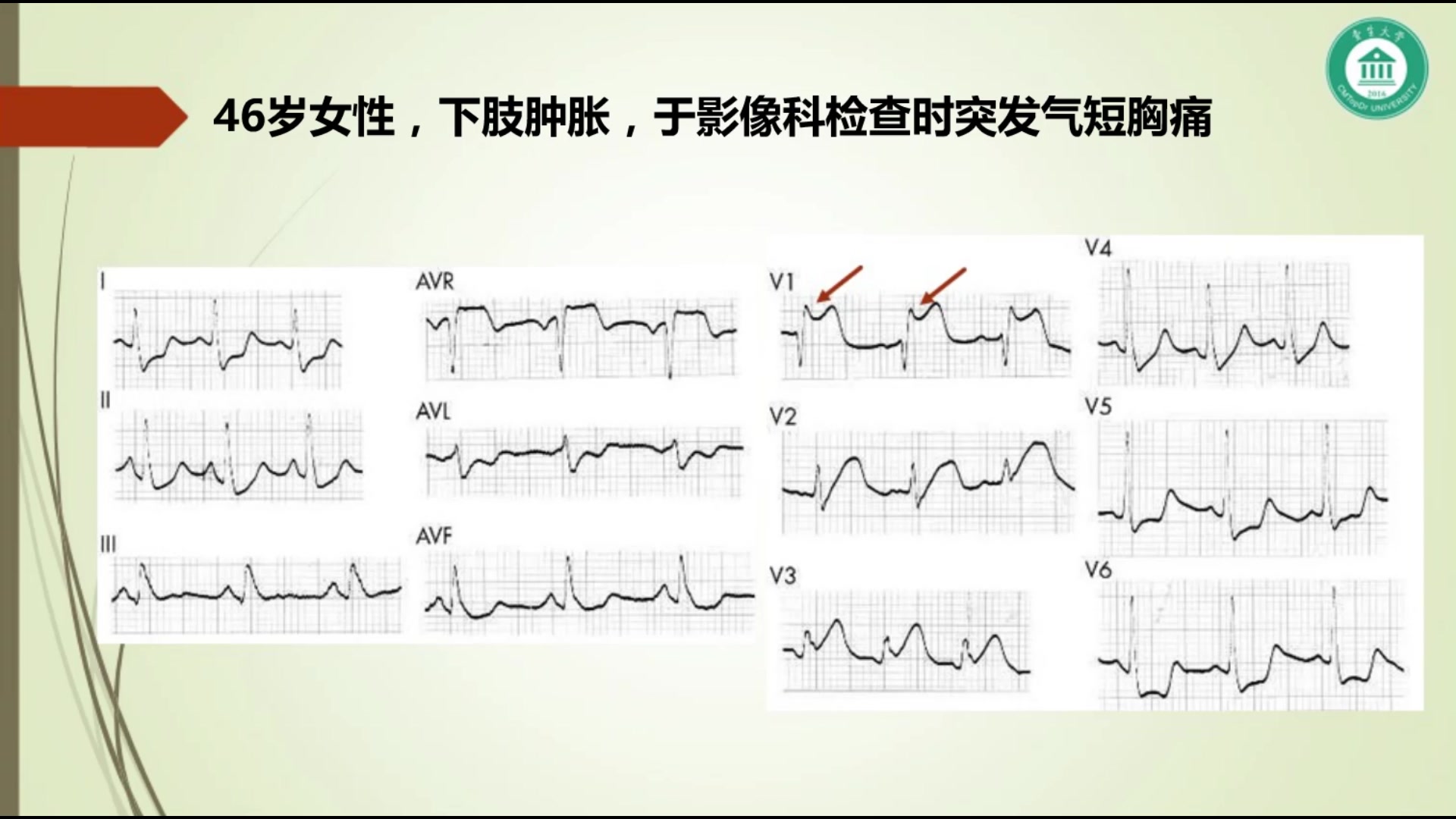 空气栓塞心电图表现图片