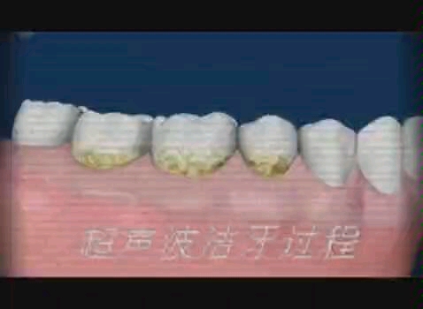 超声波洁牙!洗牙的过程你了解吗?进来看看吧!哔哩哔哩bilibili