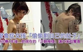 [图]厌食症女孩「偷偷割自己的肚子」，但治疗1年后…她现在的「正翻模样」让大家超惊喜！