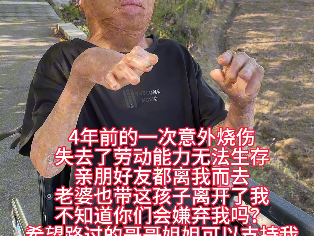 烧伤4年了,失去了劳动能力,只能来到网络上乞讨,希望有好心人士帮助,主页有帮助方式哔哩哔哩bilibili