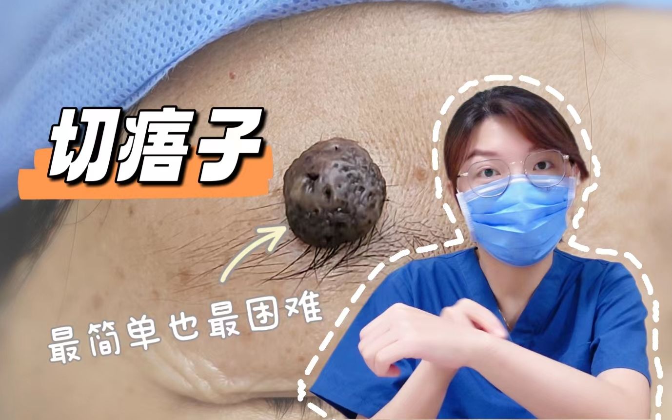 为什么切痦子要去整形外科?langers线可以用于切口设计吗?