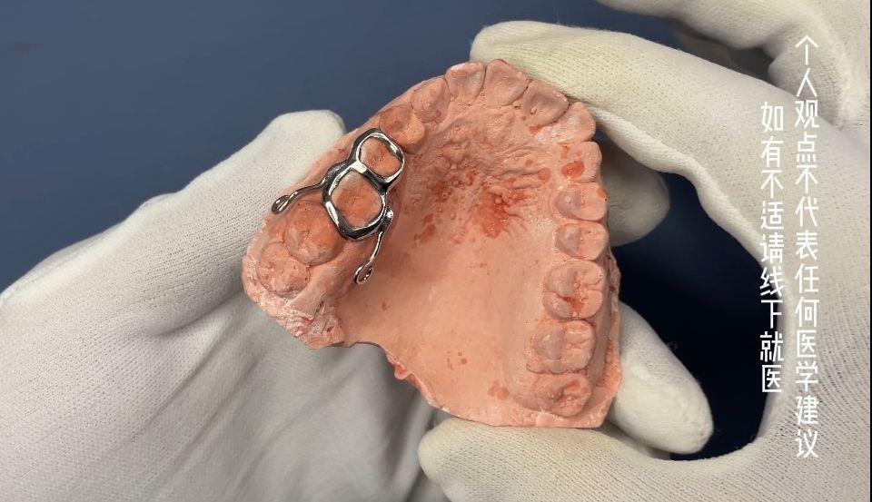 粘接式带环矫正器 妃她正畸