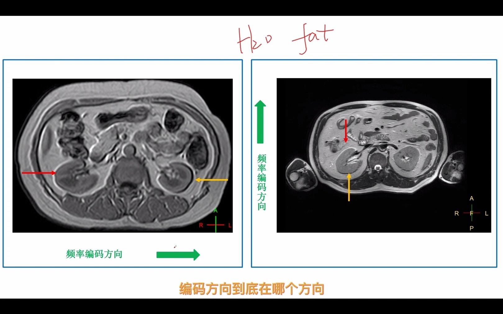 化学位移伪影表现和频率编码大小的关系哔哩哔哩bilibili