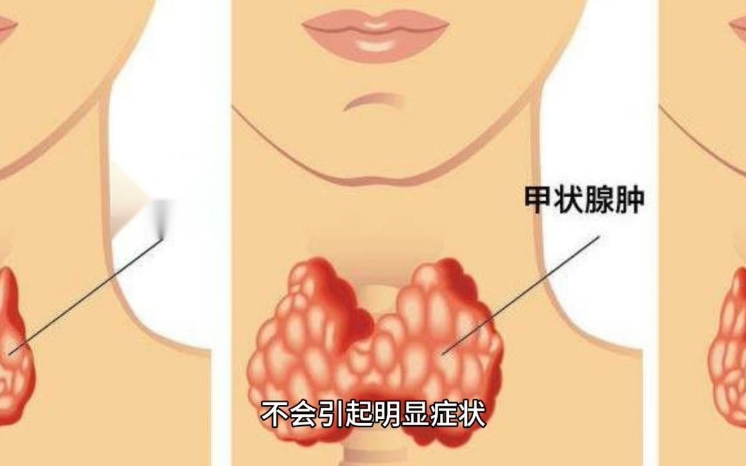 甲状腺结节长在哪里图片