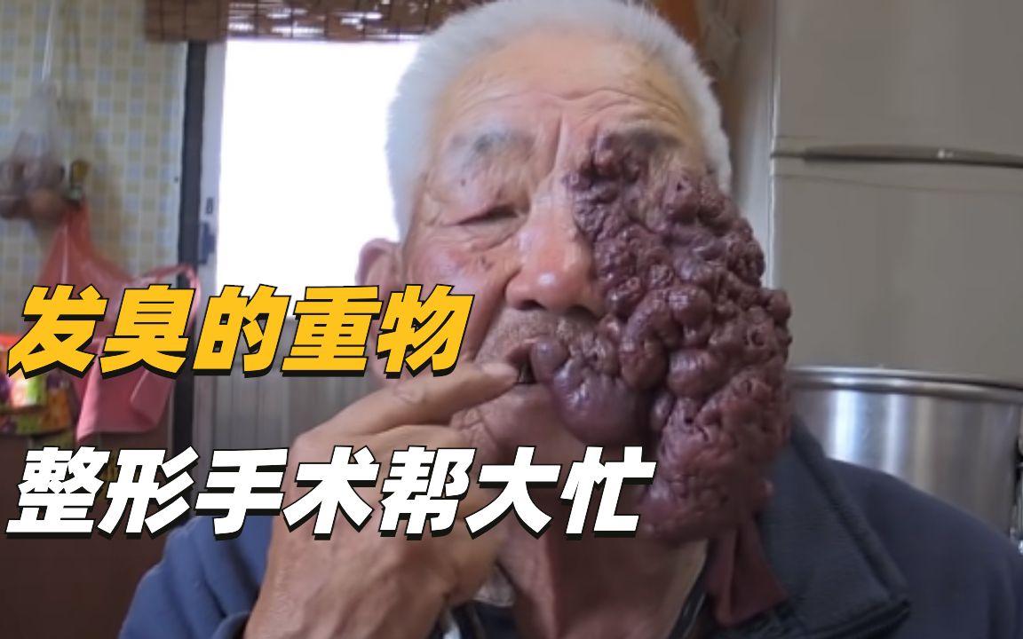 80岁大爷因为脸上重物,连儿子婚礼都不能去.吃饭往外漏,总是散发着臭气,整容后世界豁然开朗.哔哩哔哩bilibili