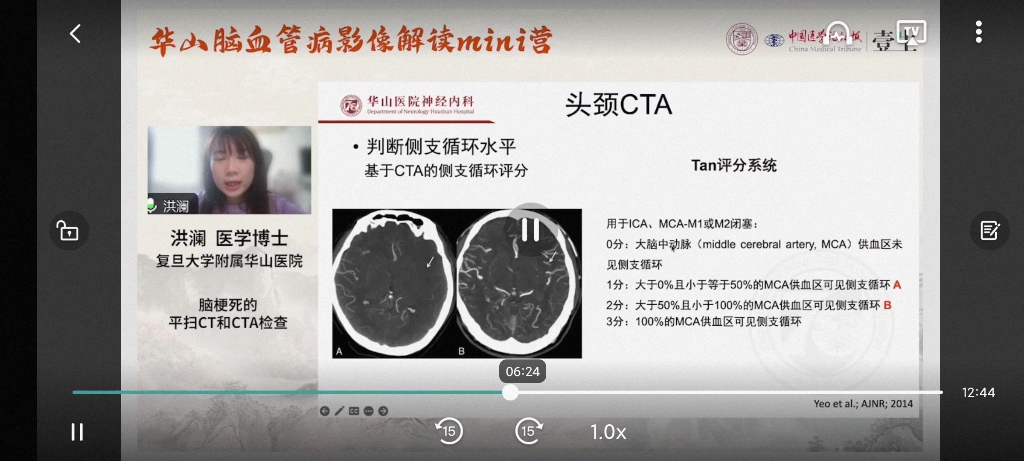 脑梗死平扫CT和CTA检查哔哩哔哩bilibili