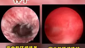 正常子宫和刮宫后样子，女性还是要好好爱护自己