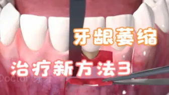医学3d动画：牙龈退缩不可怕，介绍一种新治疗方法3