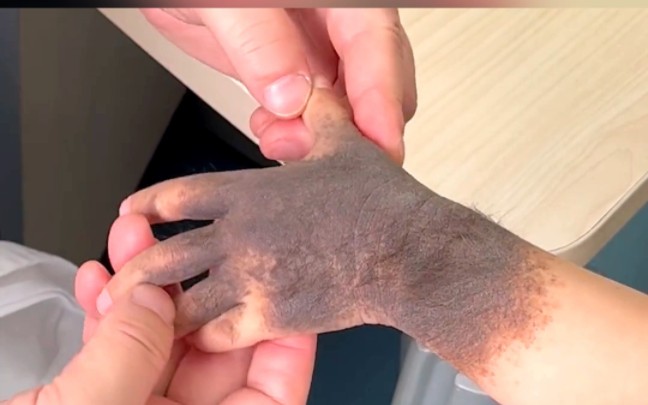 宝宝满手背的黑毛痣,毛发茂密,被小朋友说是"狼人"
