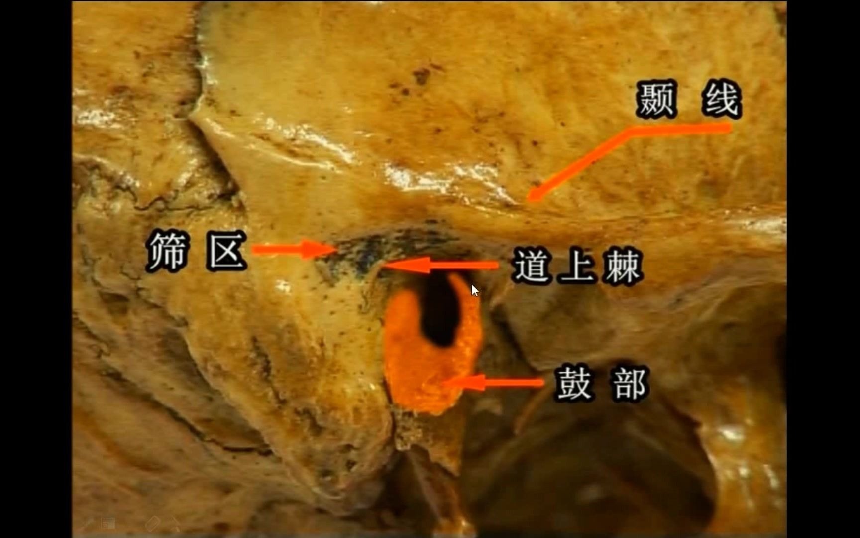 颞骨的应用解剖哔哩哔哩bilibili