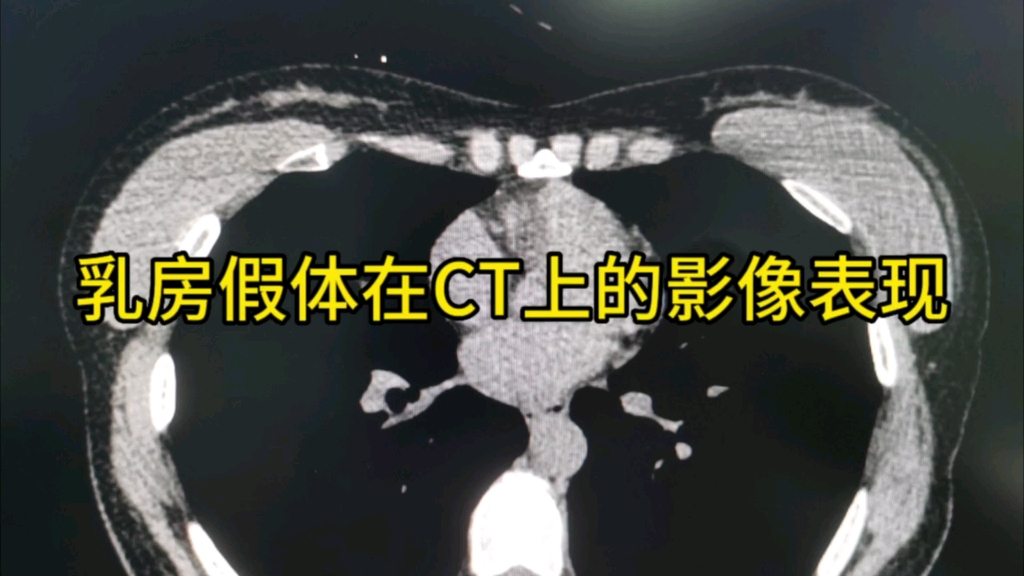 乳房假体在CT上的影像表现,工作中要注意有无破损泄露哔哩哔哩bilibili