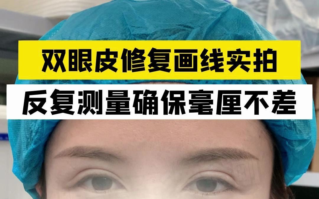 双眼皮修复画线实拍,反复测量确保毫厘不差