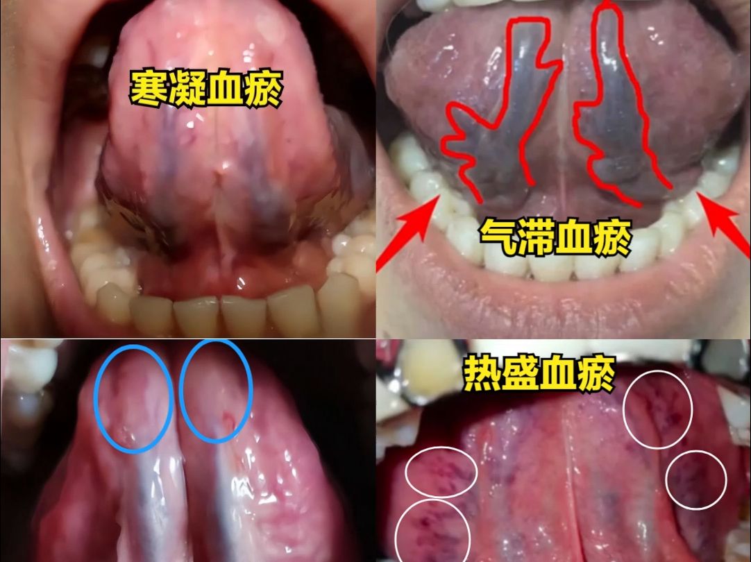 舌下瘀血怎么回事?青紫是寒,偏红是热,发叉是气滞,发淡是气虚哔哩哔哩bilibili