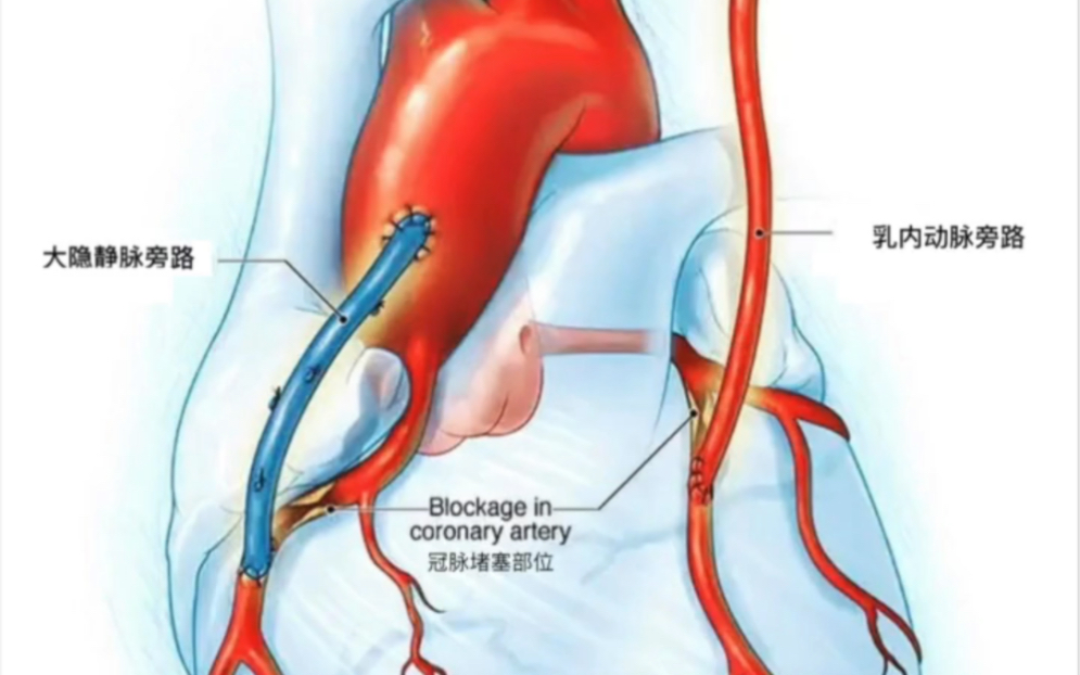 一图看懂什么是心脏搭桥哔哩哔哩bilibili
