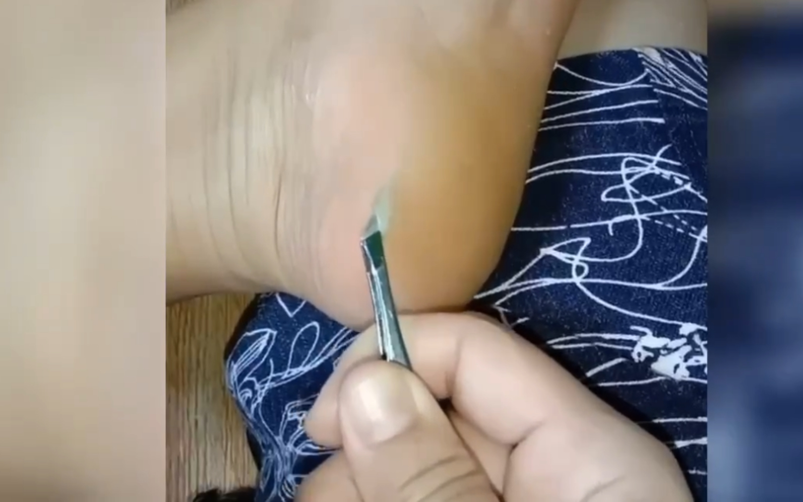 《解压总动员》:狠人拔刺挑刺系列,看小哥的脚底板扎入一个刀片,他是