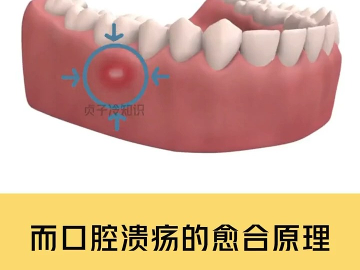 你知道溃疡的克星是什么吗?哔哩哔哩bilibili