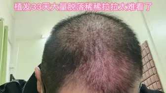 Download Video: 植发33天大量脱落，稀稀拉拉特难看，后脑勺4800个伤口还特别痒