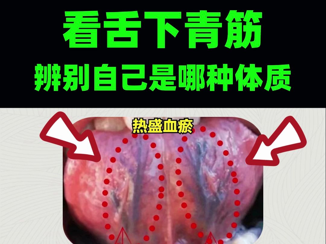 舌头下边两条“青筋”,发黑发粗,到底是什么原因引起的?哔哩哔哩bilibili