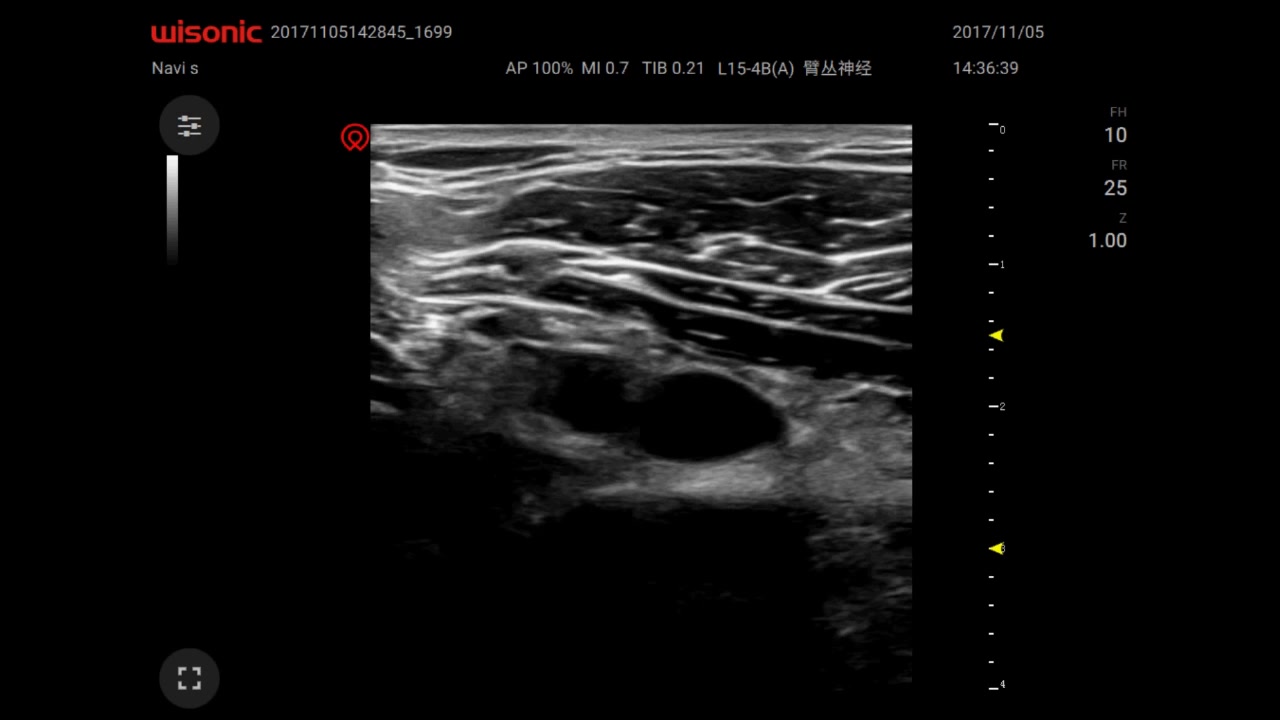 [图]超声下神经阻滞