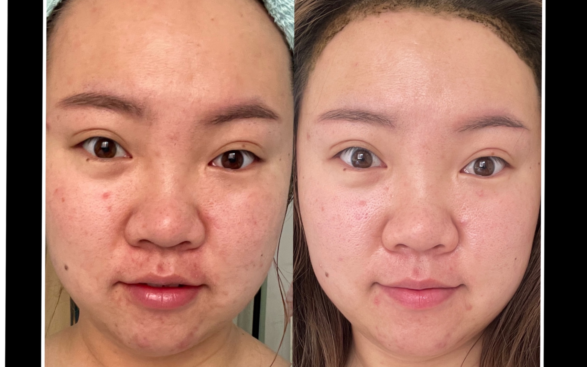 刷酸竟然还有美白的功效?十天刷酸皮肤变化