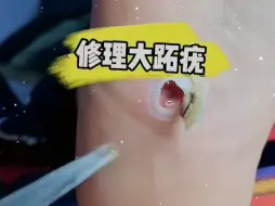 Tải video: 脚底的一颗大跖疣清理