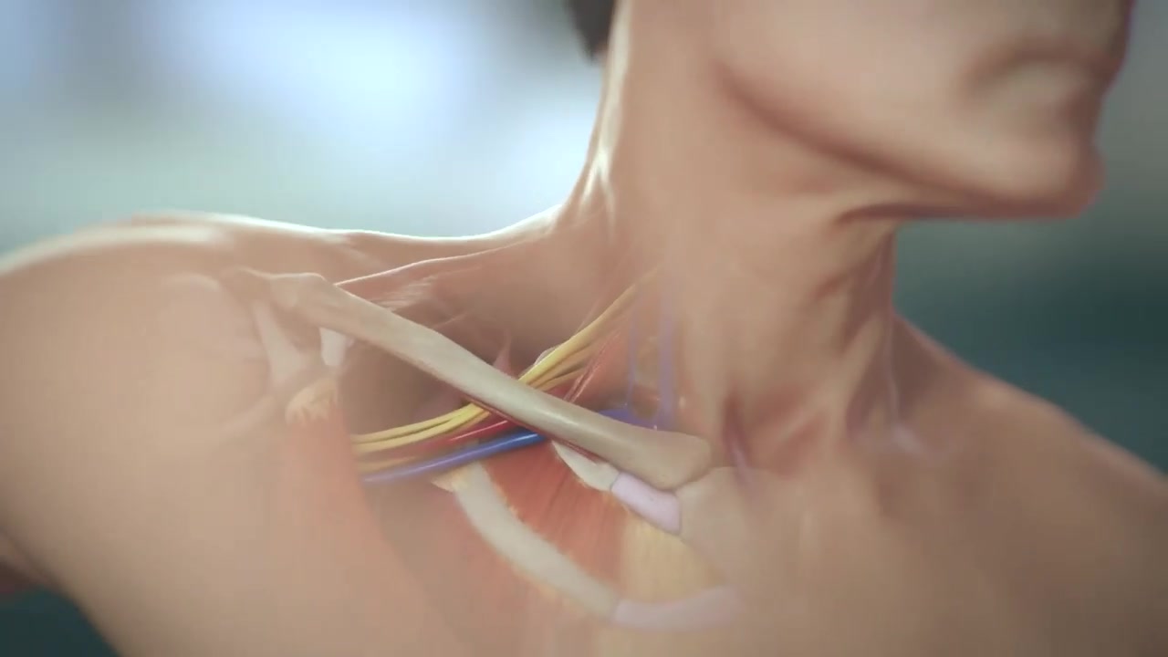 3D建模教程 Thoracic Outlet Syndrome哔哩哔哩bilibili