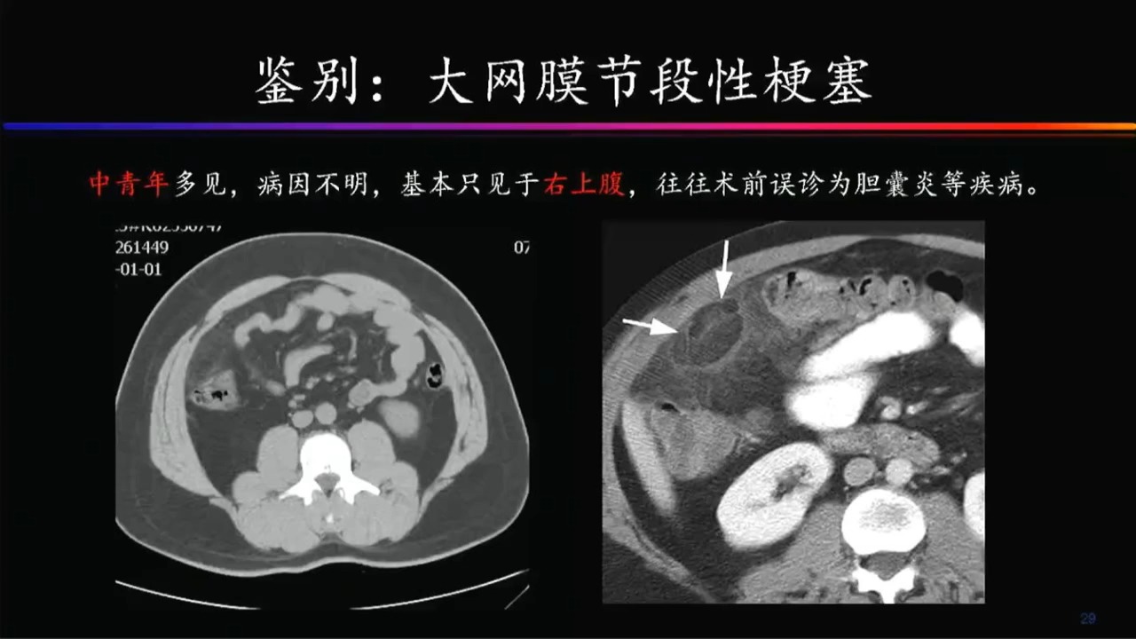 急腹症的影像学诊断与鉴别张惠茅哔哩哔哩bilibili